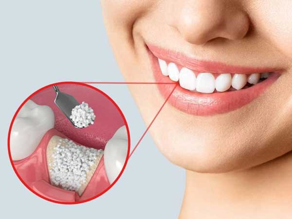 bone grafting in Delhi