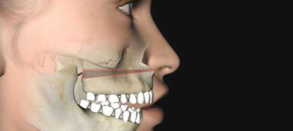 Orthognathic Surgery in Delhi