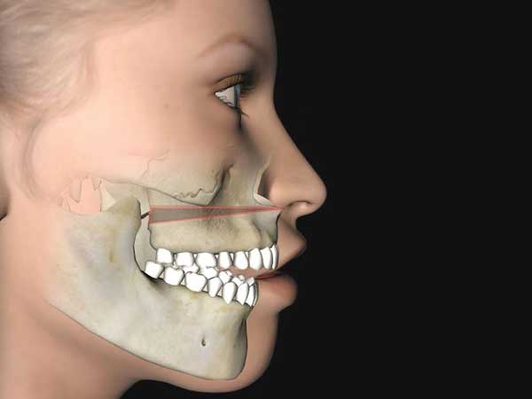 Orthognathic Surgery in Delhi