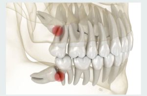 Wisdom tooth extraction in Delhi