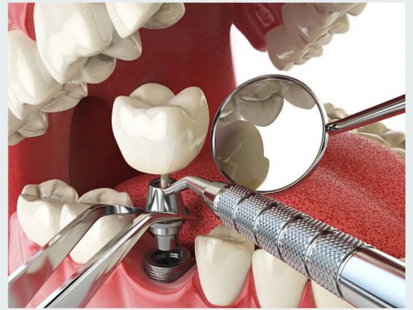 dental implant in Delhi