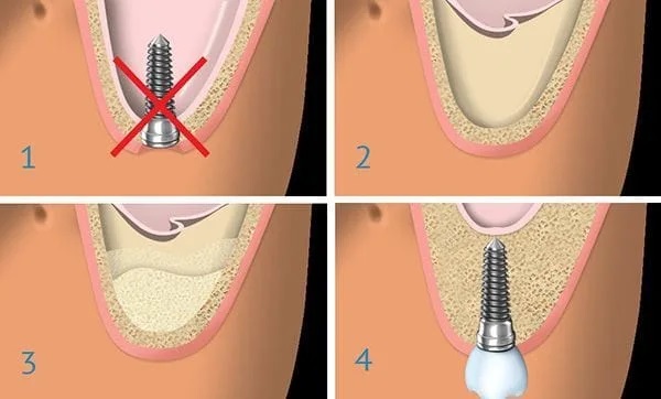 sinus lift surgery in Delhi